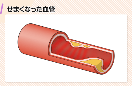 正常な血管とせまくなった血管